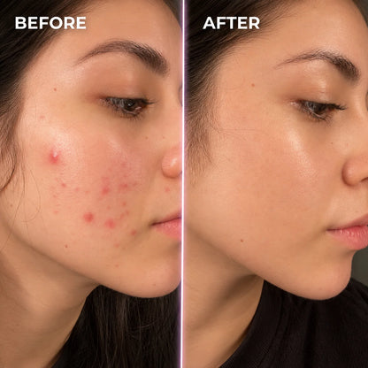 Wrinkle Retreat Pro LED Face Mask